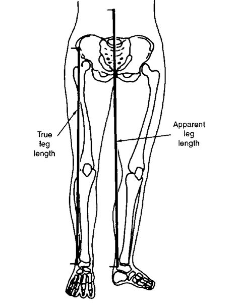 true leg length measurements